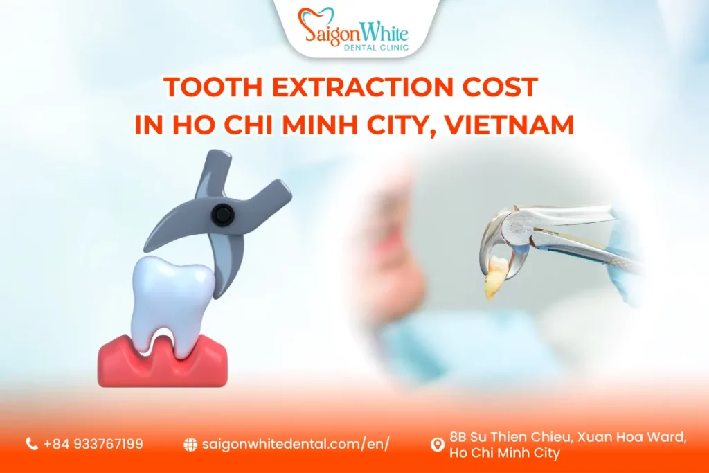 Tooth Extraction Cost in Ho Chi Minh City, Vietnam