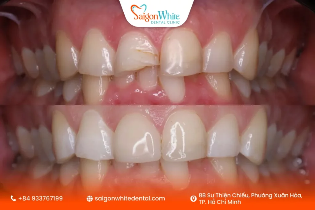 Trường hợp răng chỉ sứt mẻ nhẹ, chưa ảnh hưởng đến ngà hay tủy, bác sĩ thường chỉ định trám răng thẩm mỹ để phục hồi hình dáng ban đầu