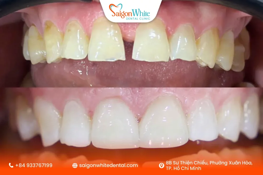 Dán sứ Veneer Emax cho răng thưa của khách hàng Nha khoa Sài Gòn White