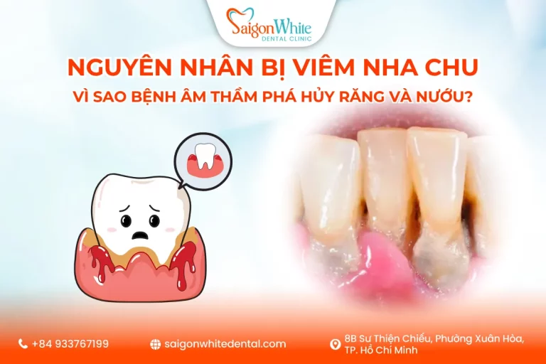 Nguyên nhân bị viêm nha chu: Vì sao bệnh âm thầm phá hủy răng và nướu?