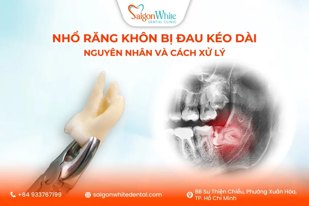Nhổ Răng Khôn Bị Đau Kéo Dài: Nguyên Nhân Và Cách Xử Lý
