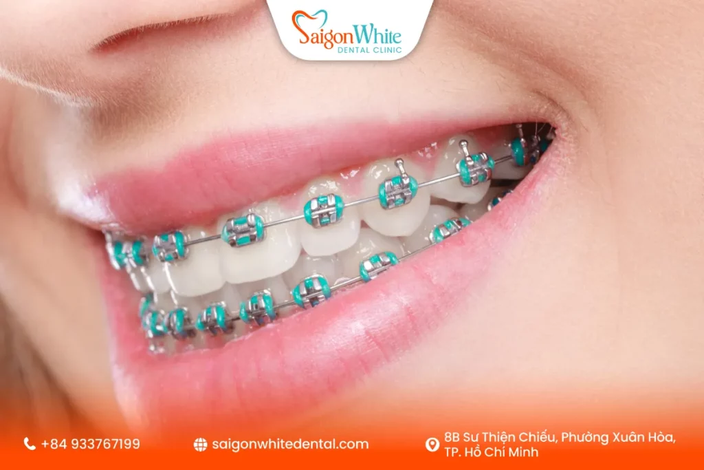 niềng răng mắc cài