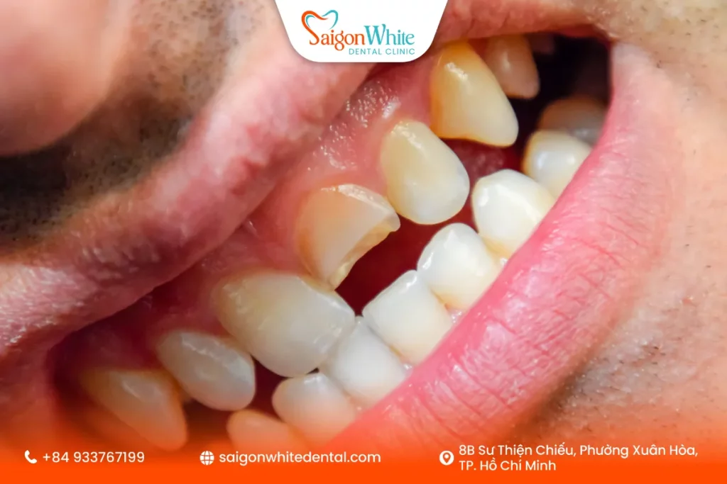 Gãy răng là tình trạng cấu trúc răng bị tổn thương