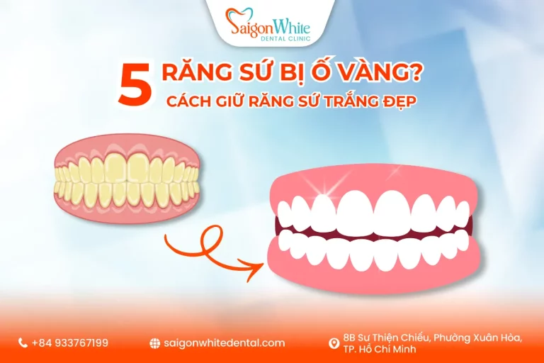 Răng Sứ Bị Ố Vàng? 5+ Cách Giữ Răng Sứ Trắng Đẹp