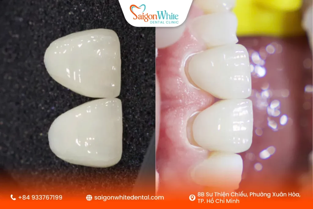Răng sứ veneer trước khi gắn cố định cho răng thưa